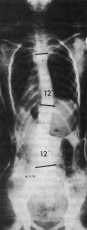 Radiografia in corsetto E.D.F.